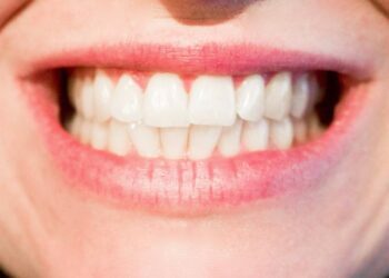 التبييض الداخلي للأسنان (1)