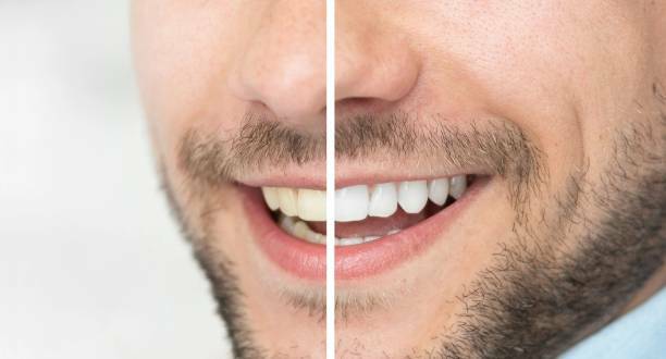 تبييض الاسنان الداخلي - تبييض داخلي للسن - internal bleaching
